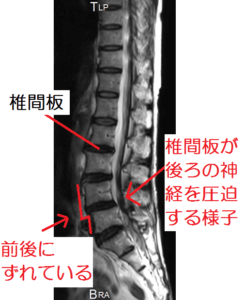 【症例報告②重いものを引っ張り腰に激痛・腰椎変性すべり症_68才・女性】 イメージ